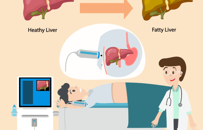 fibroscan